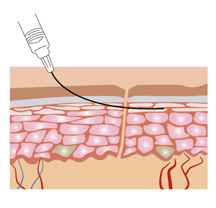 The Advantages of Micro Filler Cannulas in Facial Procedures